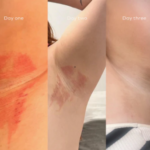 skin image of a healing progression of using the balm for eczema